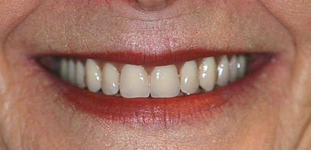 Immediate Dentures After Extraction Mc Caulley TX 79534